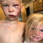 Menino de 6 anos tem rosto desfigurado por cachorro para salvar irmã