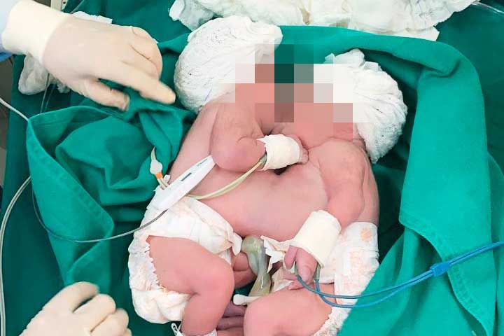 Jovem de 18 anos dá à luz gêmeas siamesas em Salvador