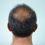 Impotência, perda de libido? É preciso ter medo de remédio para calvície?