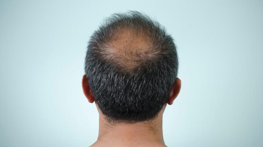 Impotência, perda de libido? É preciso ter medo de remédio para calvície?