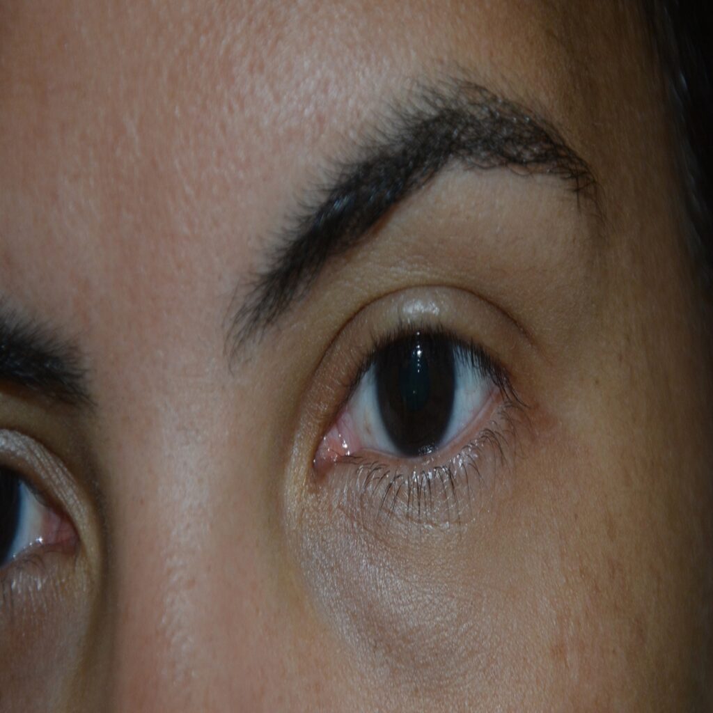 Prefeitura de Feira promove mutirão de exames de glaucoma com 400 vagas