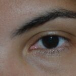 Prefeitura de Feira promove mutirão de exames de glaucoma com 400 vagas