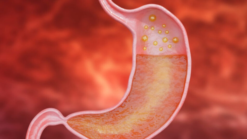 6 sintomas comuns de gastrite; saiba reconhecer