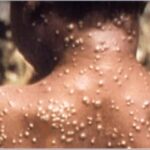 Mpox: saiba quais doenças já tiveram mais alto nível de alerta global