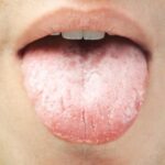 Conheça os sinais de diabetes que aparecem na boca e saiba como detectar a doença de forma precoce