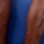 Morador de Feira de Santana com suspeita de mpox é transferido para Salvador