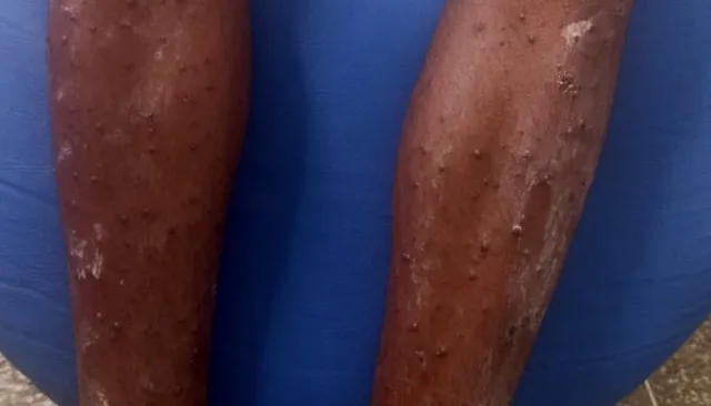 Morador de Feira de Santana com suspeita de mpox é transferido para Salvador