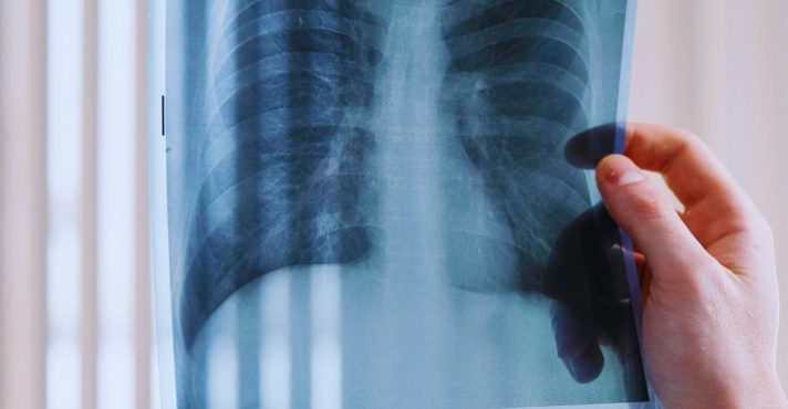 Anvisa aprova o 1º medicamento oral para câncer de pulmão em fase inicial