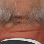 Lula é submetido a cirurgia de emergência após hemorragia cerebral