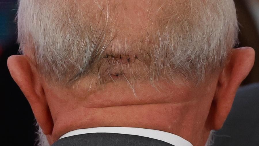 Lula é submetido a cirurgia de emergência após hemorragia cerebral