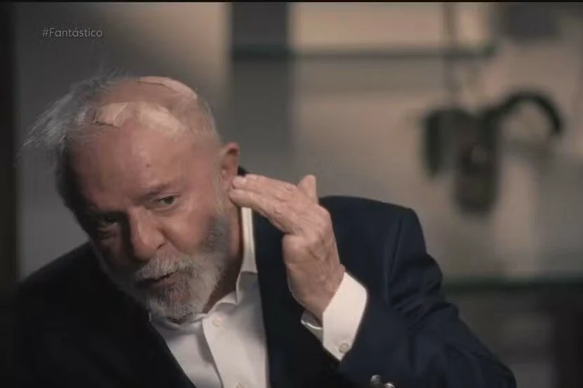 Lula diz que está com furos na cabeça e dá detalhes de acidente