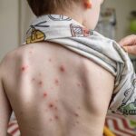 Casos de catapora registra aumento na Bahia e acende alerta