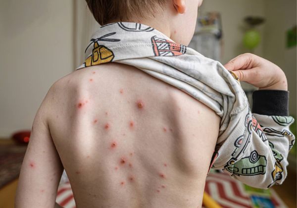 Casos de catapora registra aumento na Bahia e acende alerta