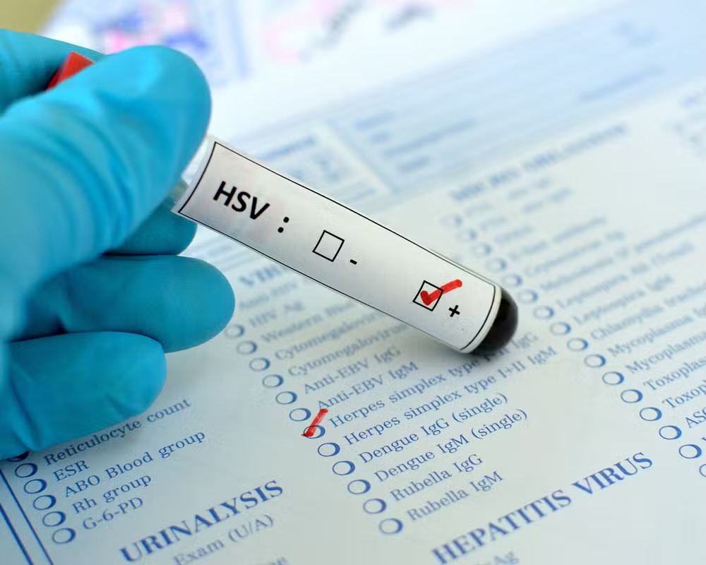 Herpes genital: o que é, sintomas e como tratar