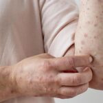 Mpox registra 149 casos em 13 estados brasileiros