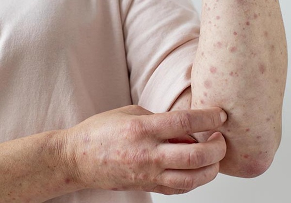 Mpox registra 149 casos em 13 estados brasileiros