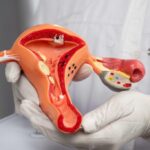 Uma a cada dez mulheres em idade fértil no Brasil sofre de endometriose, de acordo com o Ministério da Saúde.
